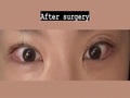 Director Do Eon-rok's Double Eyelid Revision, Eye Shape Re-correction