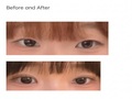 One and a half month review of Dr. Do Eon-rok's Natural Adhesion + Upper Eyelid Lift