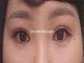 Director Do Eon-rok / Incisional Double Eyelid Revision Surgery