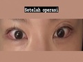 Operasi kelopak mata ganda Dr. Do Eon-rok, koreksi ulang bentuk mata