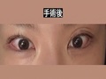 道言録院長の二重カップル再手術、目の矯正の再校正