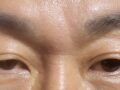 Men's double eyelid surgery reviews