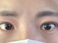 双眼皮修复（降低线条） 术后反馈