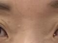 自然粘连+上眼角