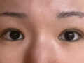上眼角+自然粘连