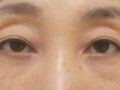 Director Do / Incision, Eyelid Correction, Upper and Lower Eyelid Fat Grafting