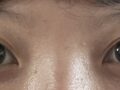 双眼皮修复  术后反馈