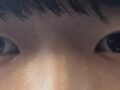 全切双眼皮+提肌+上眼角  术后反馈