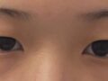 都彦禄院长 术后反馈