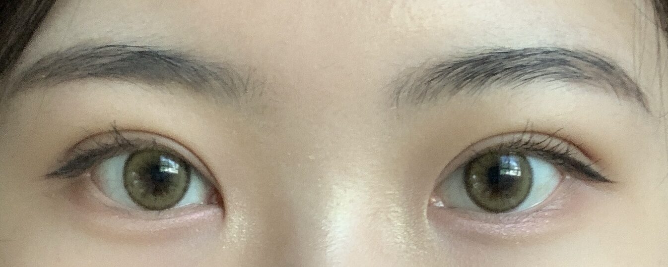 术后