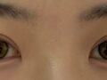 One Month Review of Director Do Eon-rok's Natural Adhesion Treatment