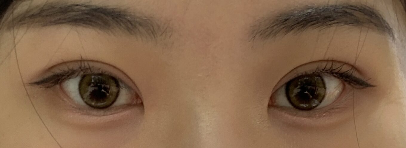 术后