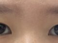 埋线双眼皮+提肌