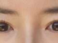 Non-incisional + Upper Eyelid Surgery Director Do