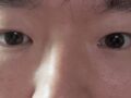 まぶたまぶた/目の矯正/ウィット2ヶ月後期