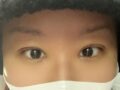 Dr. Kim Hong-jin Incision Double Eyelid Surgery Review