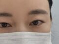 Dr. Kim Hong-jin's Eye Surgery Buried Suture Review