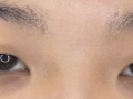 Incision + Eyelid Correction + Upper Eyelid Lift -> Thank you, Director Do ^^