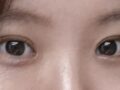 都彦禄院长   双眼皮+前眼角  满意
