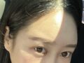 自然粘连  都彦禄院长 术后反馈