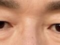 眼底脂肪重排  术后反馈