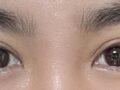 Eye Surgery (Buried Suture + Upper Eyelid Lift) / Director Do Eon-rok