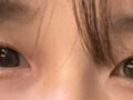 都彦禄院长   自然粘连 术后反馈