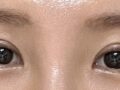 Review of Director Kim Hong-jin (Natural Adhesion + Upper Eyelid Lift)
