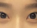 Director Do Eon-rok - Under-eye Fat Repositioning