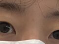 都彦禄院长  术后反馈
