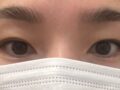 自然粘连+上眼角   都彦禄院长
