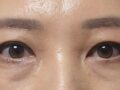 Eye surgery reviews