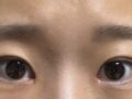 埋线双眼皮  术后