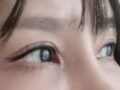 都彦禄院长   双眼皮修复