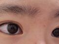 一毫米    都彦禄院长   双眼皮+上眼角  术后反馈
