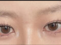 1mm eye surgery reviews