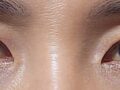 Director Do Eon-rok of Ilmiri, Eyelid Fat Grafting + Double Eyelid Surgery + Eyelid Correction