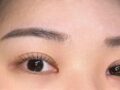 一毫米 双眼皮修复 术后反馈