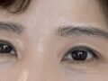 埋线双眼皮  术后反馈