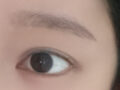 初眼  自然粘连+上眼角 术后反馈