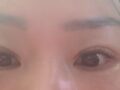 自然粘连双眼皮修复