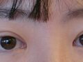 全切双眼皮+提肌  修复