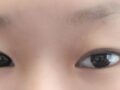 全切双眼皮+上眼角+后眼角,眼睑下至