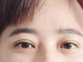 埋线+提肌