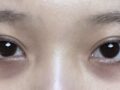 Double eyelid surgery + under-eye bags review