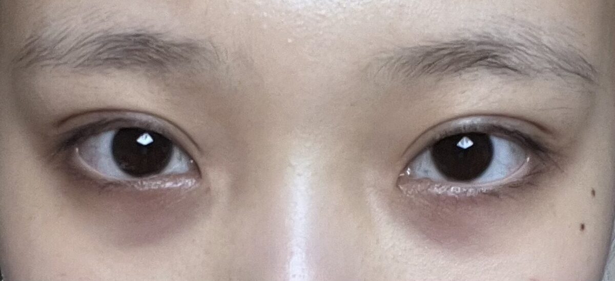 双眼皮手术+眼下脂肪重排