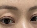 都彦禄院长  埋线双眼皮（修复）