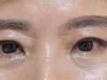 目のペアカップル手術