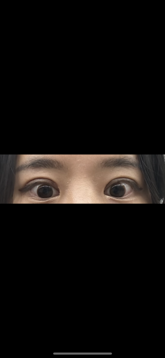 双眼皮修复 - 都彦禄院长❤️
