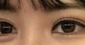 Review of Dr. Do Eon-rok's double eyelid re-surgery
